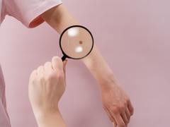 Melanomový den v Nemocnici Kyjov – přijďte si zdarma zkontrolovat znaménka